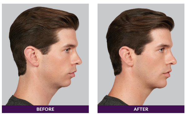 Jawline Support Sleep Tape